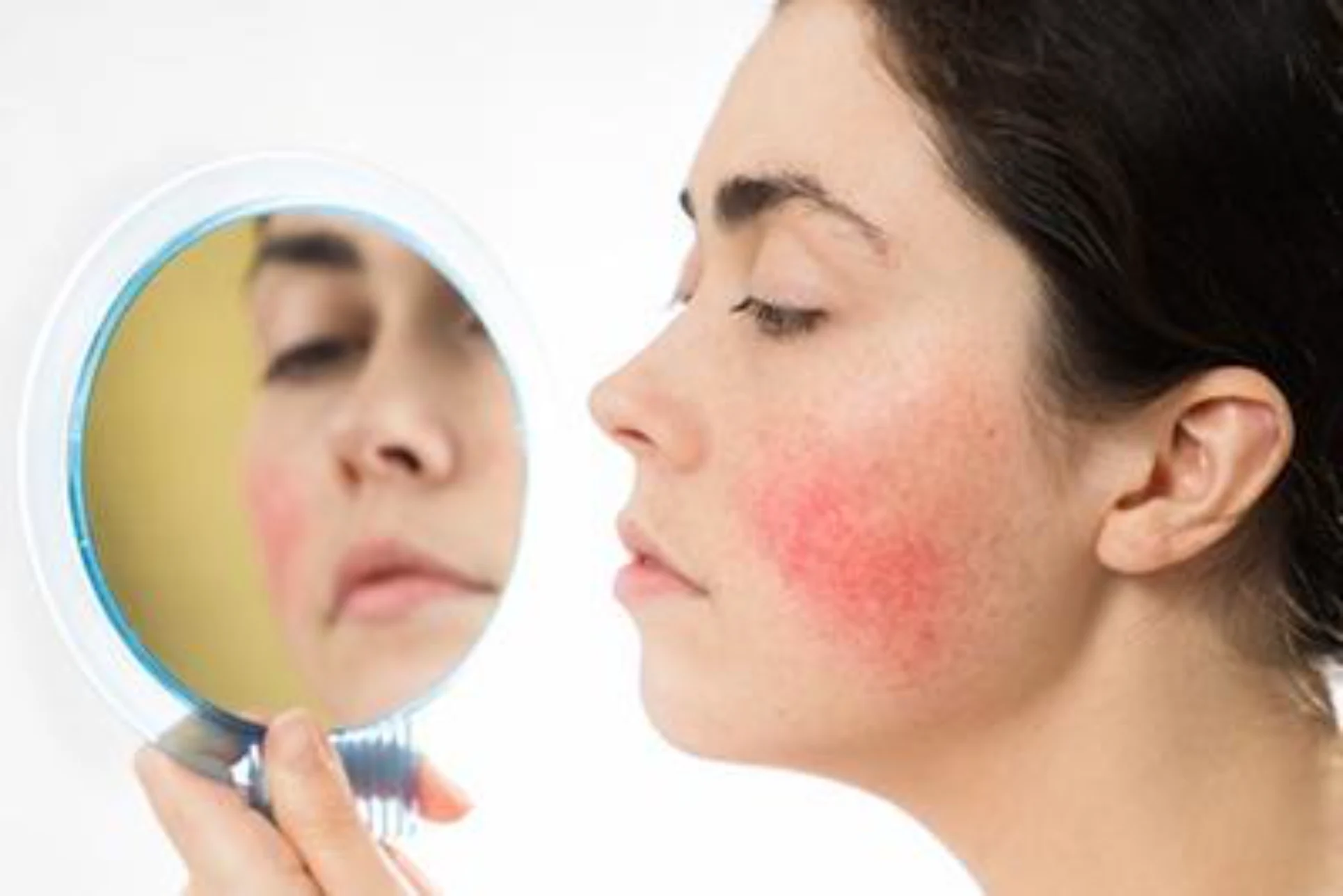 Rosacea treatment for facial redness in Ithaca NY