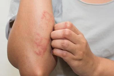 Inflamed skin rash evaluated in Cortland NY