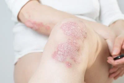 Chronic scaly skin condition care in Cortland NY