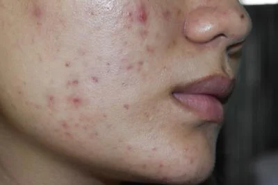 Cystic acne treatment in Ithaca NY dermatology clinic