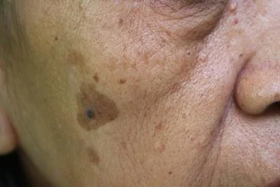 Skin lesion evaluation in Cortland NY