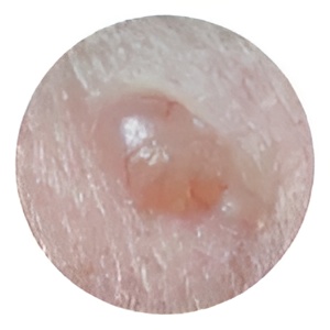 Atypical skin lesion examined by dermatologist in Cortland NY